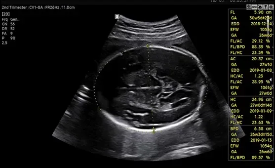 Ультразвук Samsung, демонстрация работы алгоритма RealisticVue™, плод, лицо