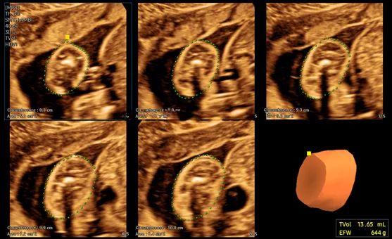 Ультразвук Samsung, демонстрация работы MV-Flow™ с LumiFlow™, плод, мозг