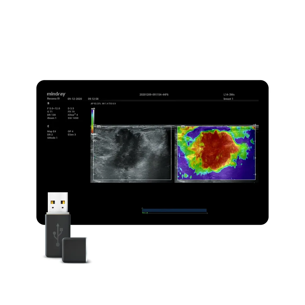 NTE (Natural Touch Elastography), фото 1