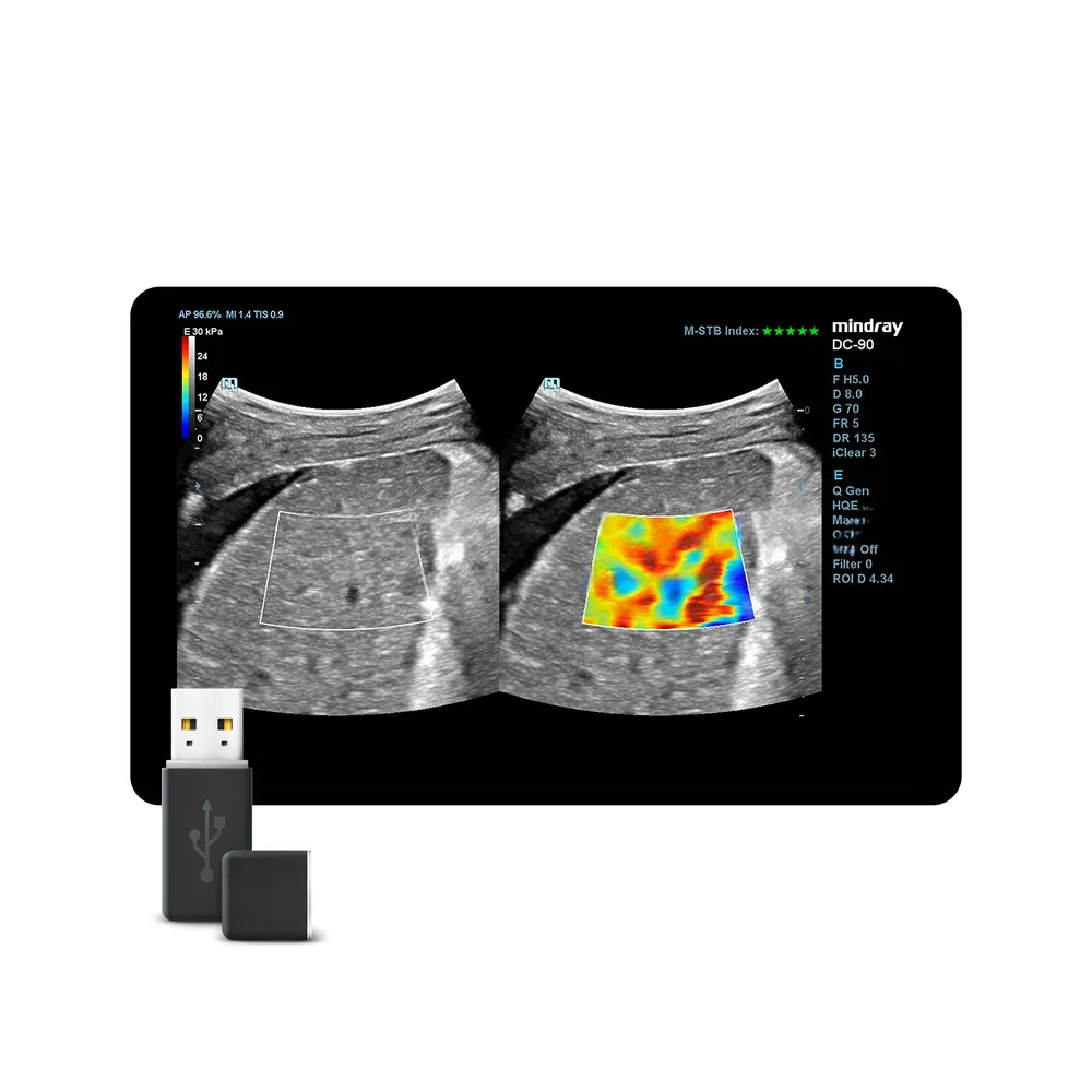 STE (Sound Touch Elastography), фото 1