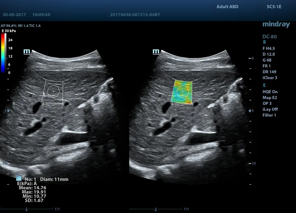 STE (Sound Touch Elastography), фото 2