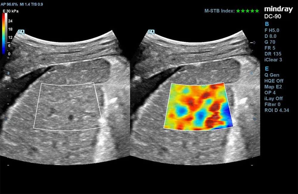 STE (Sound Touch Elastography), фото 3