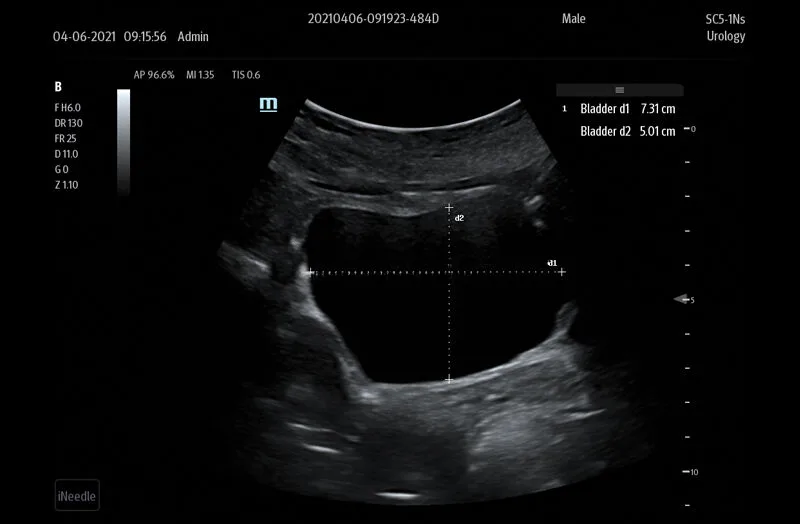 Smart Bladder, фото 2