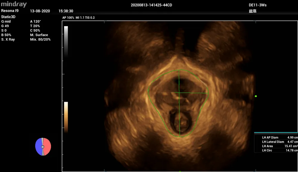 Smart Pelvic, фото 2