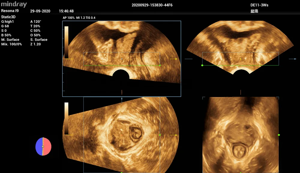 Smart Pelvic, фото 3