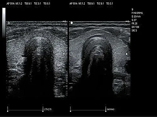 Speckle Reduction Imaging